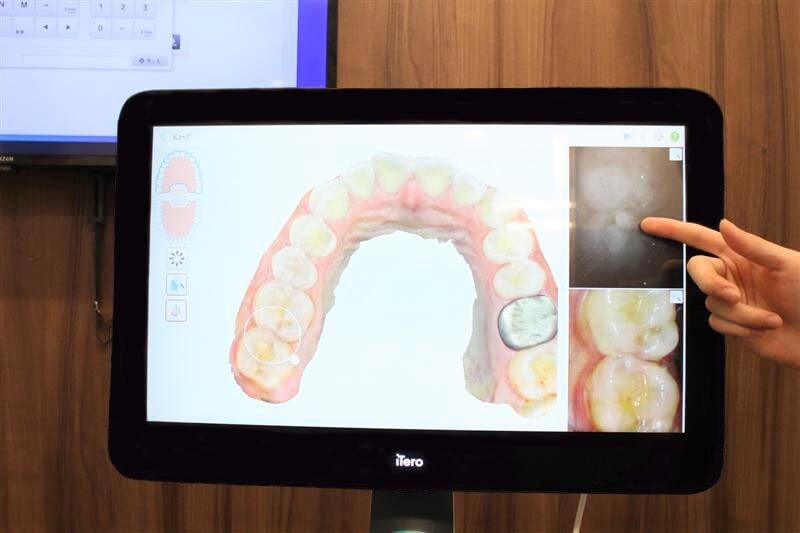 デジタルスキャナーで小さな虫歯を予防的に発見！3Dでご自身の歯が見えるため、歯の色や形の気になる所が見やすいです！