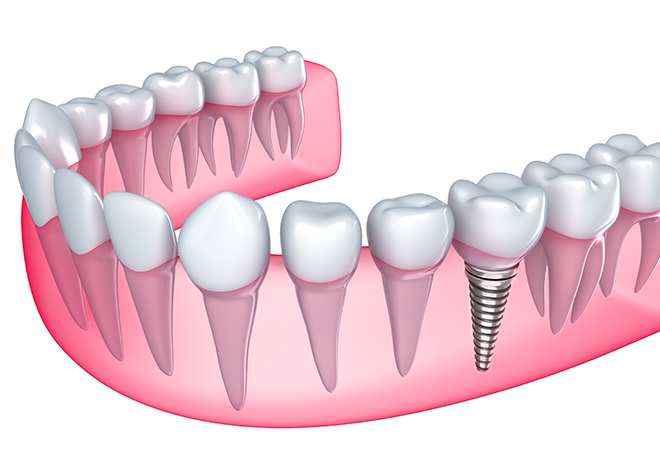 失った歯を補う方法として、インプラント治療があります