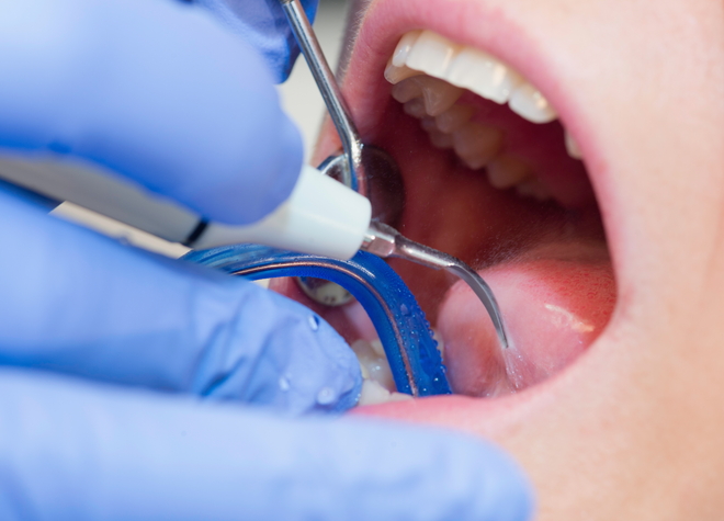 歯科医院で行うPMTCは歯磨きで落とせない部分をキレイにしてくれますので、虫歯予防につながります