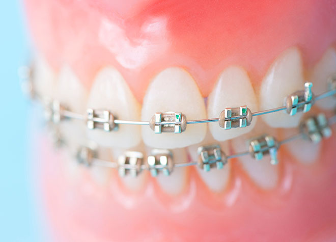 虫歯や歯周病予防につながる矯正歯科
