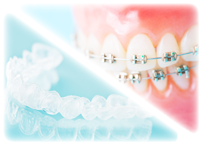 お口全体に配慮した矯正治療で、虫歯や歯周病のリスク軽減を目指しましょう