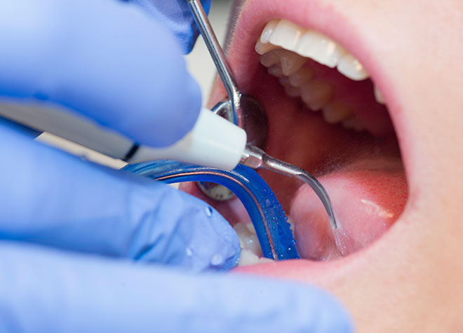 Q.歯周病とはどのような病気ですか？