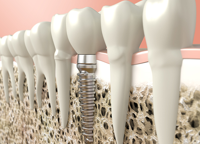 Q.歯を失ってしまった場合、どのような治療を受けられるのでしょうか？