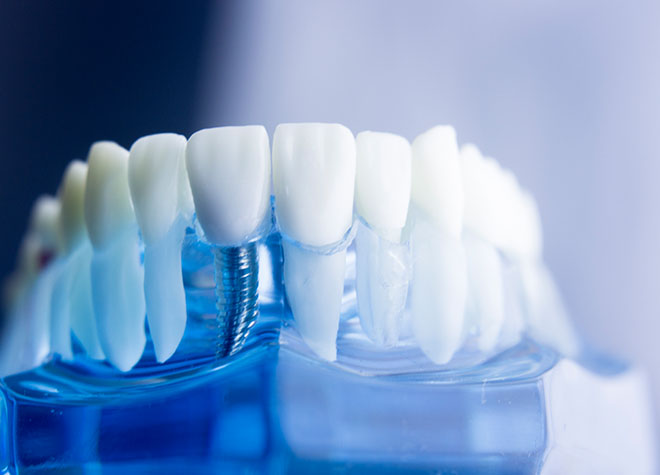 歯を失った方に天然の歯に近い機能性を持つインプラントをおすすめします
