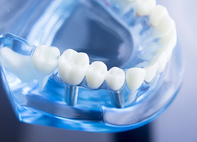インプラント治療で他の歯を守りながら、口内環境を作り上げましょう