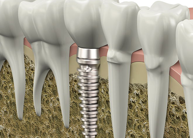 周りの歯に負担が少ないインプラント治療もご用意しています