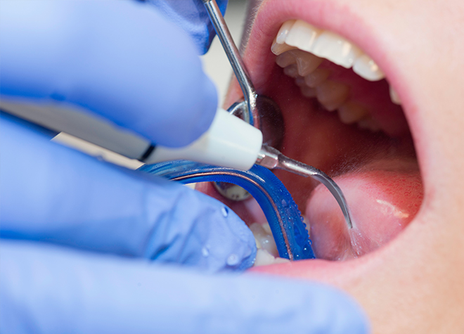 虫歯になりにくい、自然な歯にするために歯科医院でのクリーニングをご活用ください