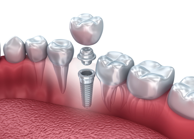 失った歯を補う手段の一つとして、ご希望の患者さまにインプラント治療を提案しています