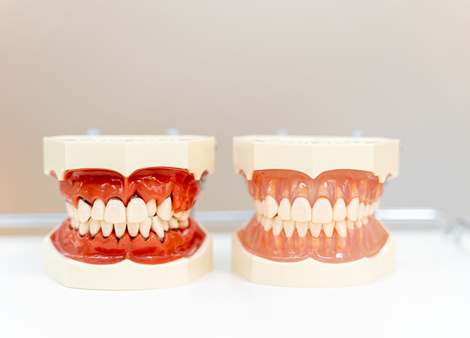 大切な歯を長持ちさせるために、歯周病の原因となる歯石をていねいに取り除いています