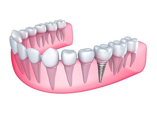 天然歯の感覚に近い義歯治療が、インプラント治療です
