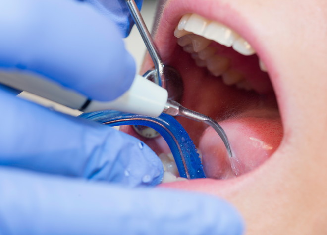 歯周病を防ぐためには、歯科医院での定期的なチェックが大切です