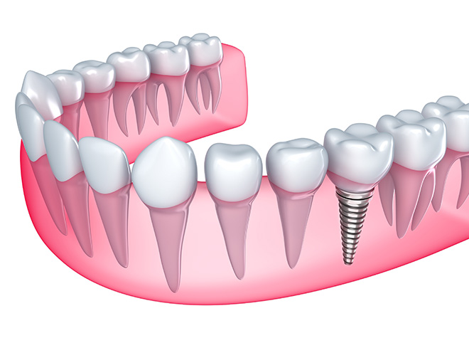 歯の欠損部分を補う方法の一つに、天然歯のように噛めるインプラント治療があります