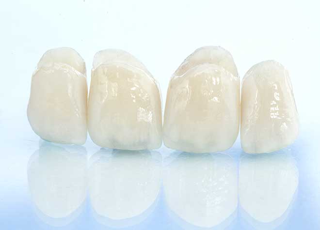 保険の白いかぶせ物から、虫歯が再発しにくいゴールドまで、様々な素材をご用意しています