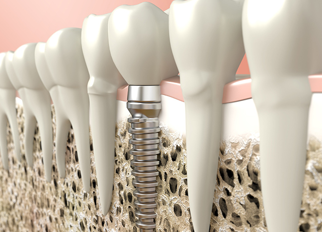 インプラント治療の前に、歯茎や骨など土台の部分の診断を行うことが重要です