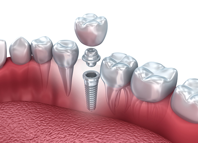 欠損してしまった歯を補うには、インプラント治療がおすすめです