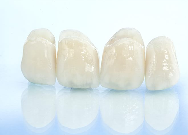 つめ物・かぶせ物治療では他の歯と並んでも違和感のない素材を使用しています