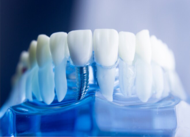 ご自身の歯のように食事や会話を楽しめます