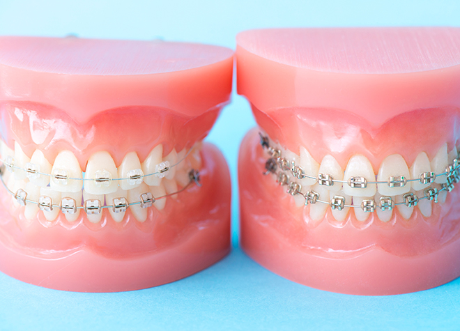 歯並びをよくすることで、虫歯や歯周病の予防にもつながります