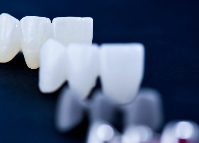 歯科医師が患者さまと相談しながら、つめ物・かぶせ物の素材を選択する方針です