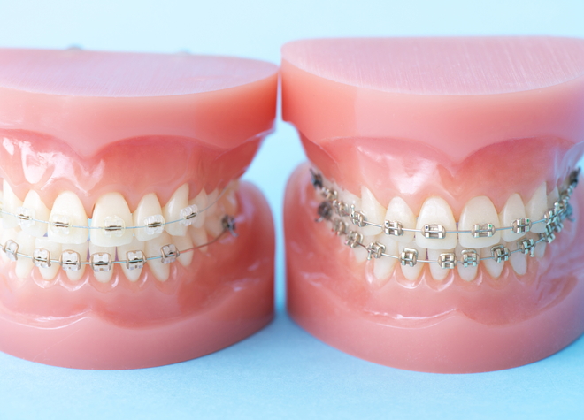 歯並びの見た目を整えるだけでなく、噛み合わせが整うなど、健康維持にも役立つ点が挙げられます。