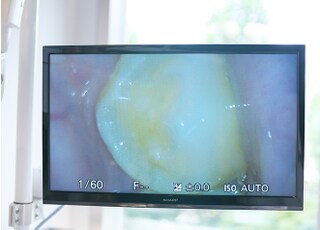 歯の現状を撮影し、詳しくご説明します。