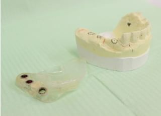 歯科ナチュラル インプラント
