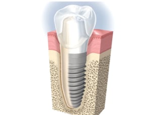 仙北坂歯科クリニック インプラント