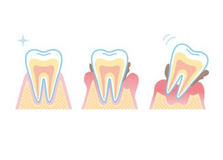 高尾歯科医院 歯周病の保存療法
