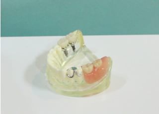 中山歯科 インプラント