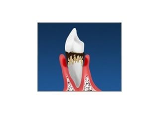 大野歯科クリニック 歯周病