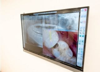 口腔内カメラ画像。虫歯の箇所・大きさなどをモニターにて説明させていただきます。