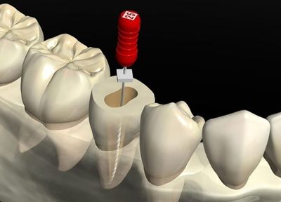 虫歯が進行してしまった場合の根管治療