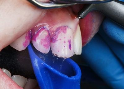 歯科検診の重要性