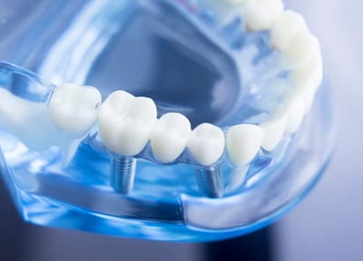 歯科ナチュラル インプラント