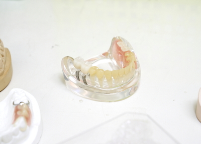 金属床やノンクラスプデンチャーなどの自由診療の入れ歯も取り扱っています
