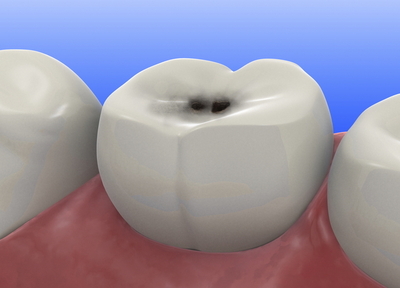 抜歯は最終手段と考え、できる限り削らない・抜かない治療を目指します