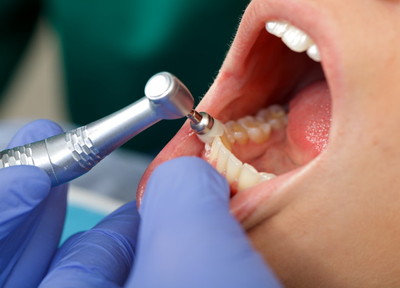 より歯周病を予防できるようにクリーニング以外の施術も行います