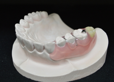 ぐらついている歯を固定しつつ、歯のない部分を補う入れ歯があります