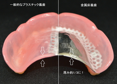金属床義歯なら噛んだときの違和感が少なく、温度もしっかり感じられやすくなります