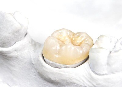 ヨシタケ歯科医院 つめ物・かぶせ物