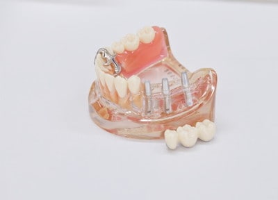 小野歯科医院 つめ物・かぶせ物