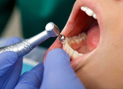 進行段階に合わせた治療を行うことで、大切な歯を失うことを防げます