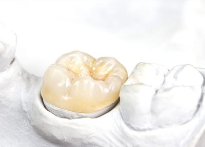 西新宿歯科ＴＯＹＯクリニック（WST歯科） つめ物・かぶせ物