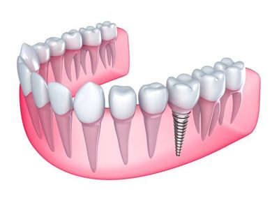 しのざき歯科（中央区） インプラント