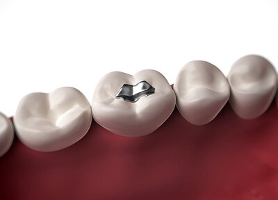 医療法人とくつファミリー歯科クリニック 虫歯