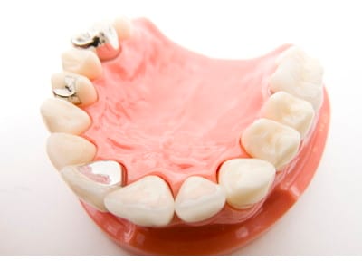 いそわき歯科 つめ物・かぶせ物