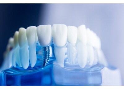 ＴＯＰＳ　ＤＥＮＴＡＬ　ＣＬＩＮＩＣ インプラント