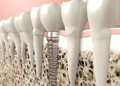 ガイドを用いた手術で、リスク軽減や手術時間の短縮に努めています