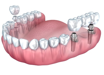 型取り・上部構造の装着