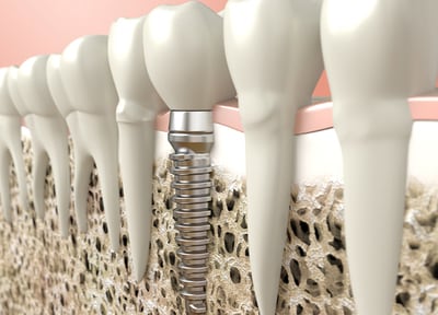 患者さまの状況に合わせた、リスクの少ないインプラント治療に努めています